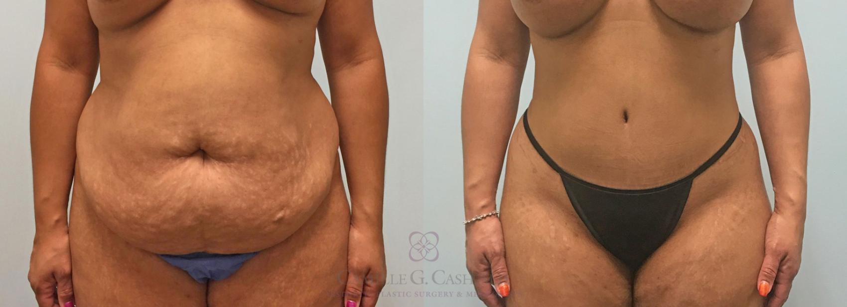 Before & After Liposuction Case 309 View #1 View in Houston, TX