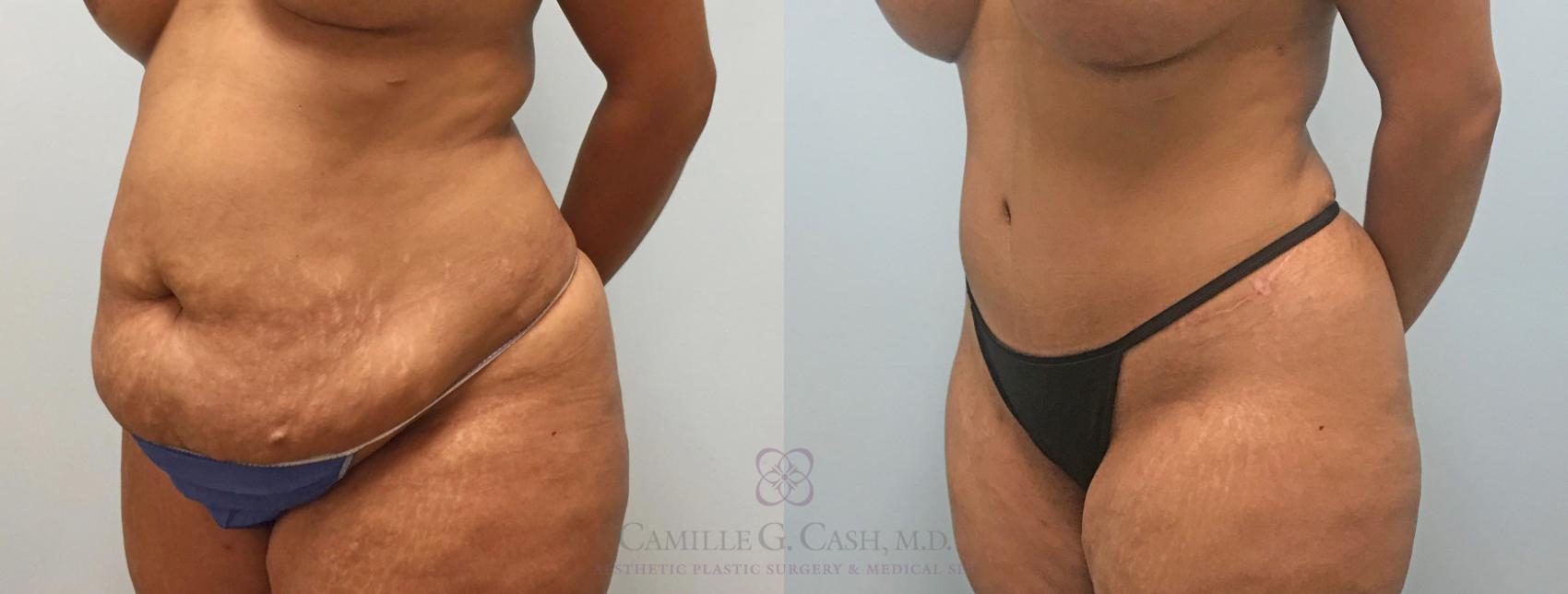 Before & After Liposuction Case 309 View #2 View in Houston, TX