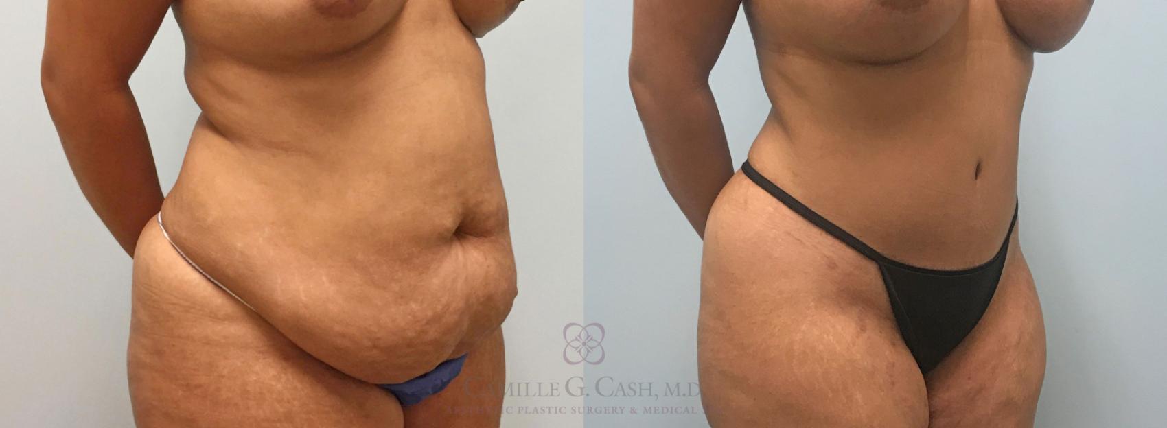 Before & After Liposuction Case 309 View #3 View in Houston, TX