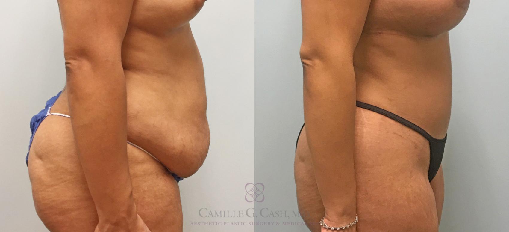 Before & After Liposuction Case 309 View #4 View in Houston, TX