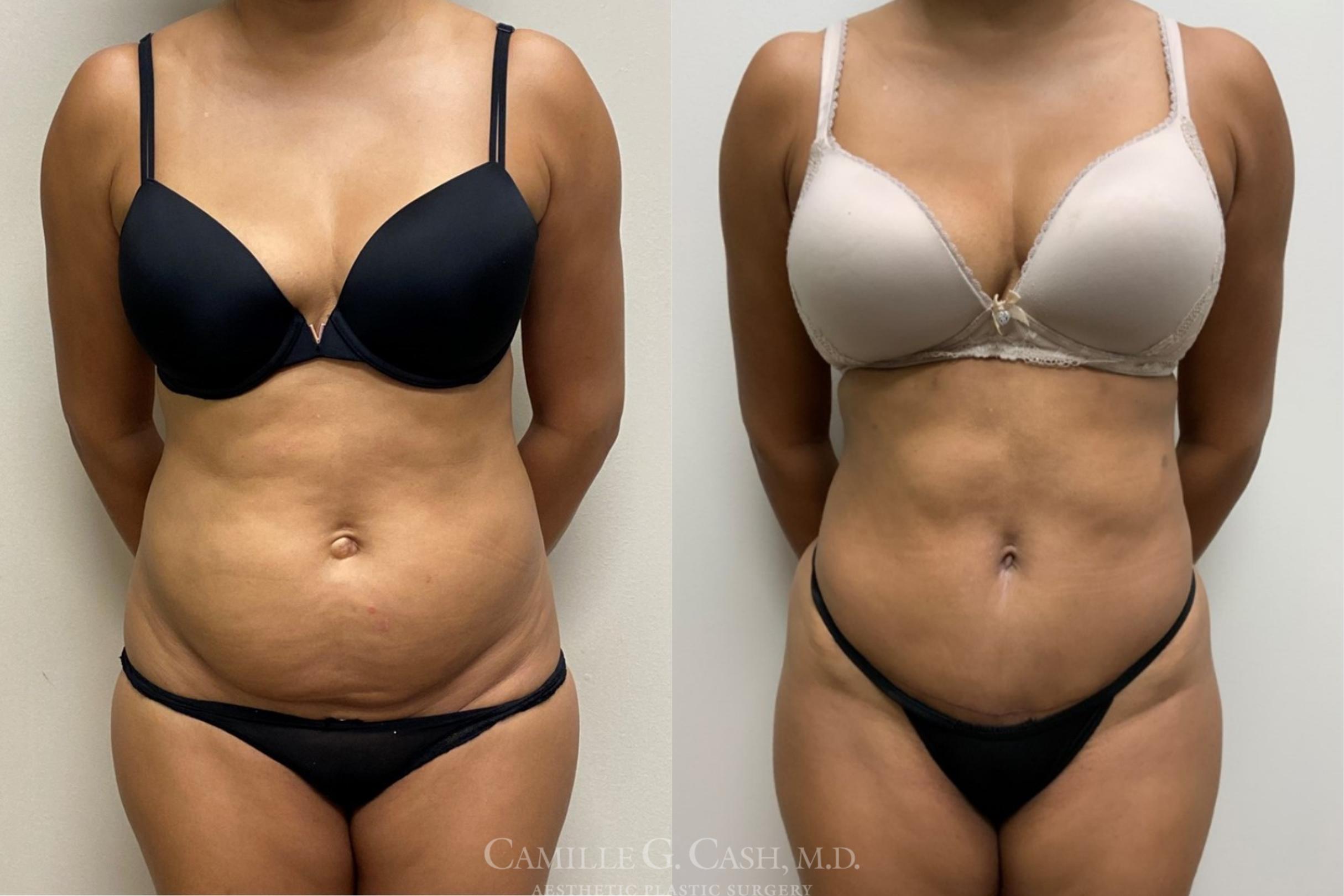 Liposuction Before and After Photo Gallery | Houston, TX | Camille Cash,  M.D.