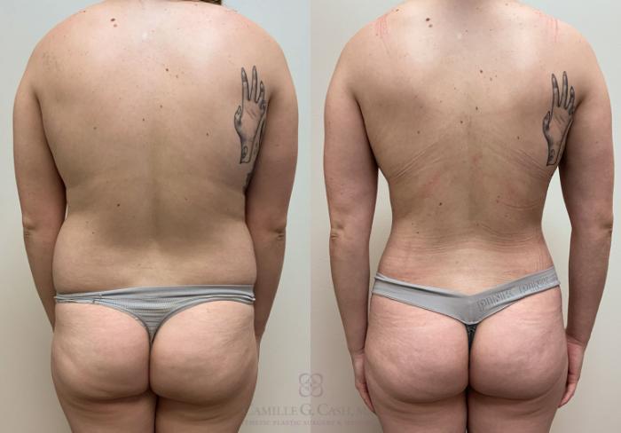 Before & After Liposuction Case 415 View #1 View in Houston, TX