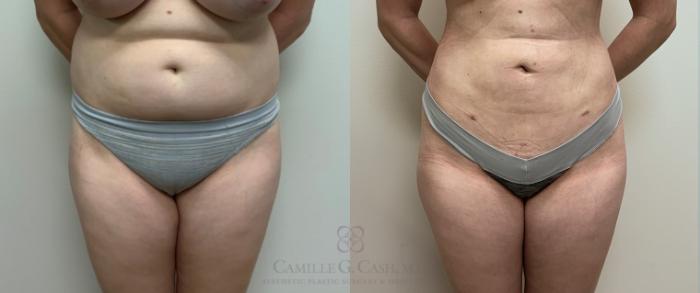 Before & After Liposuction Case 415 View #2 View in Houston, TX