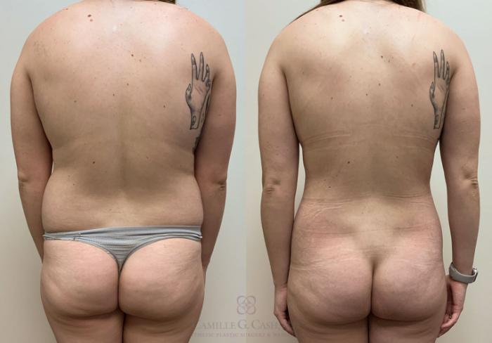 Before & After Liposuction Case 415 View #3 View in Houston, TX
