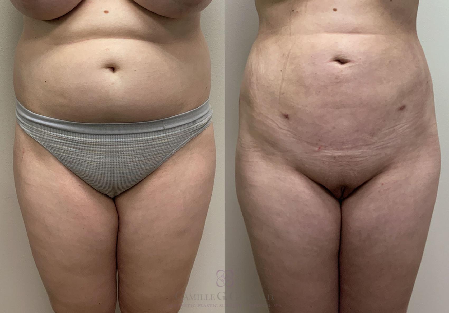 Before & After Liposuction Case 415 View #4 View in Houston, TX