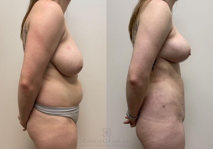 Before & After Liposuction Case 415 View #5 View in Houston, TX