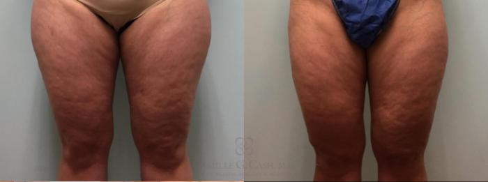 Before & After Liposuction Case 526 Front View in Houston, TX