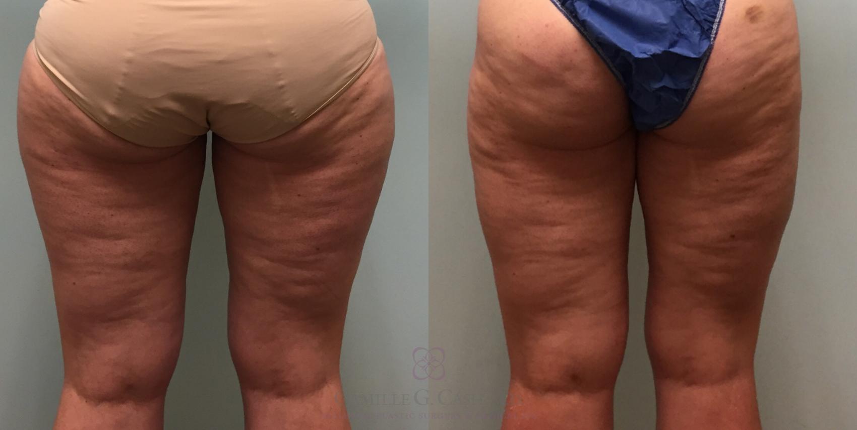 Before & After Liposuction Case 526 thighs back View in Houston, TX
