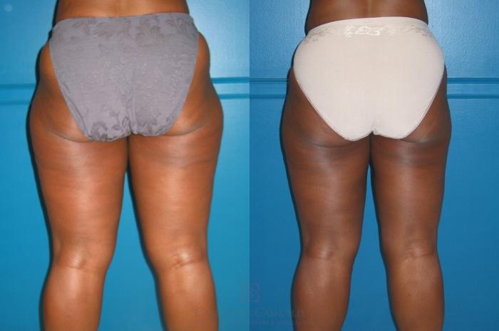 Before & After Liposuction Case 530 Back View in Houston, TX