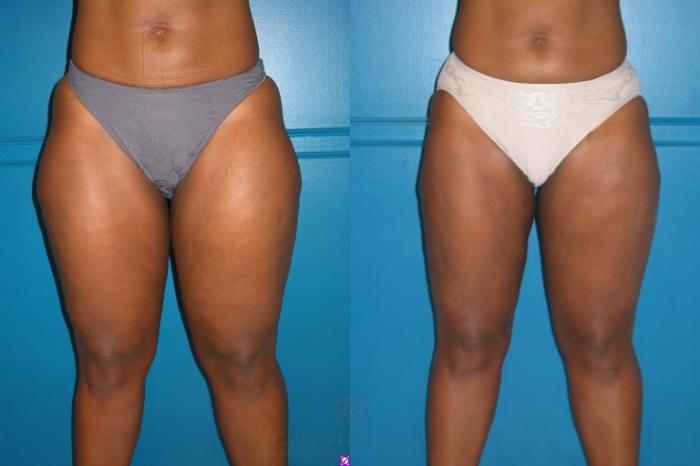 Before & After Liposuction Case 530 Front View in Houston, TX