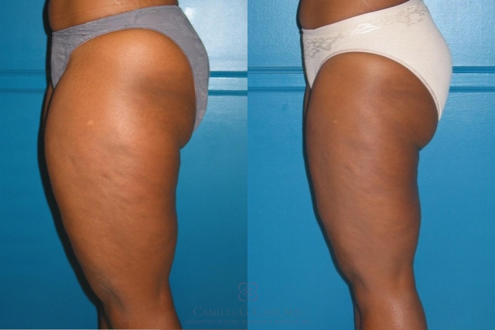 Before & After Liposuction Case 530 Right Side View in Houston, TX
