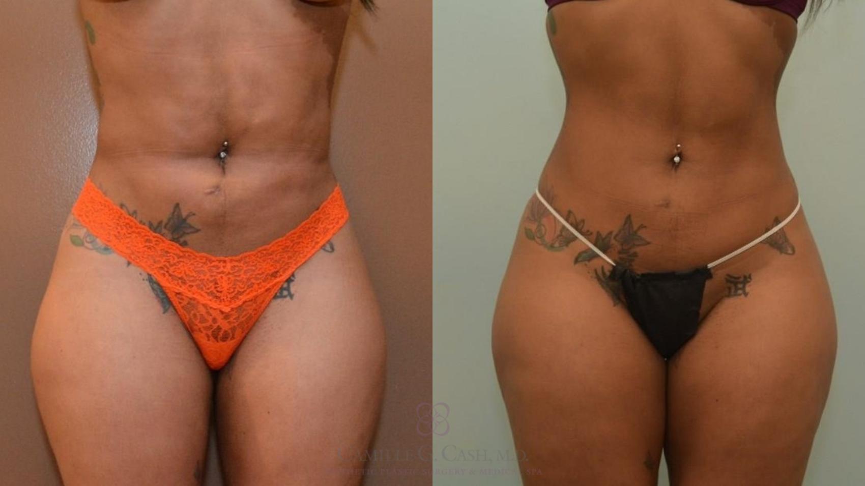 Before & After Liposuction Case 547 Front View in Houston, TX
