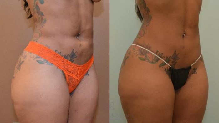 Before & After Liposuction Case 547 Left Oblique View in Houston, TX
