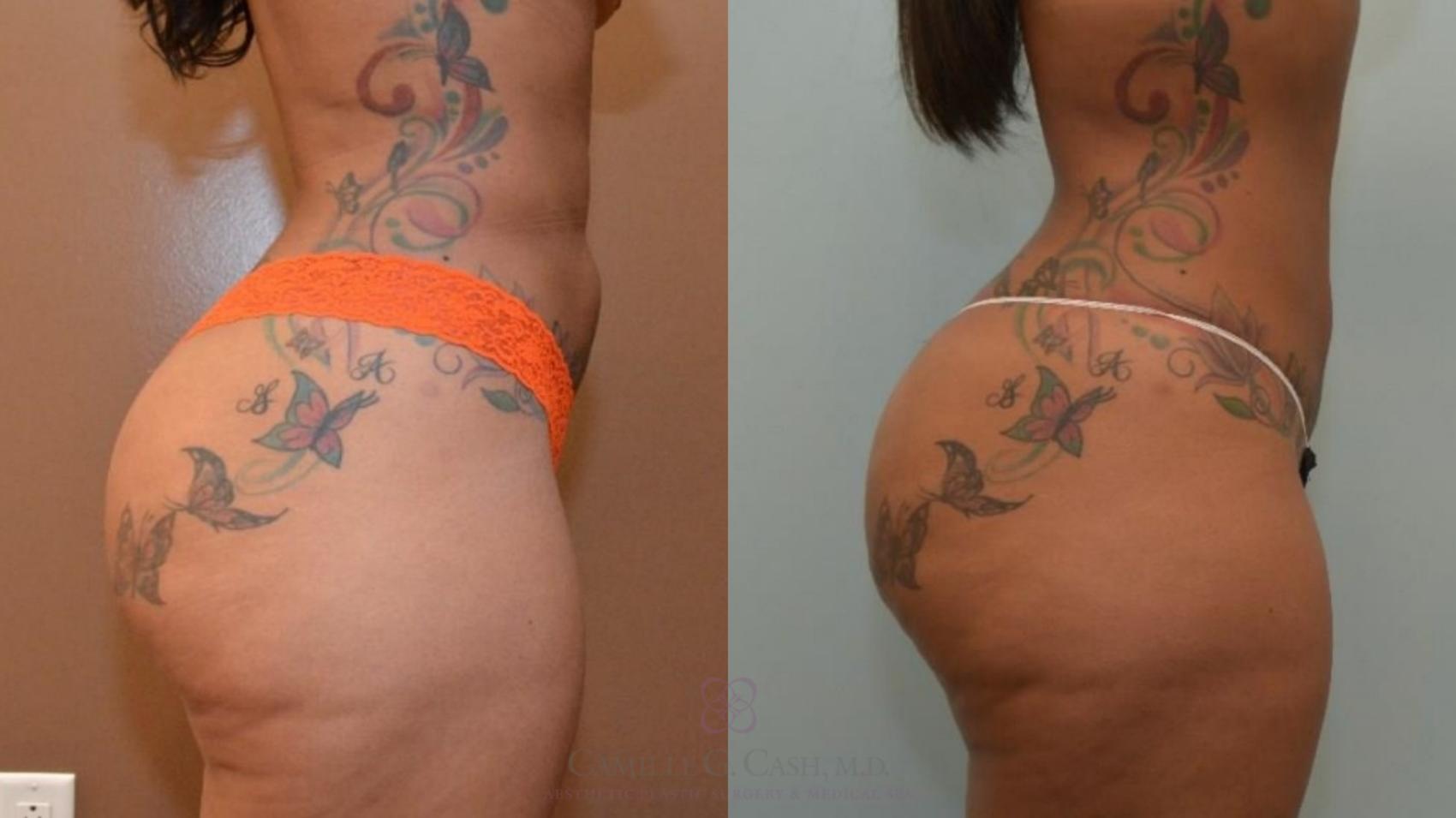 Before & After Liposuction Case 547 Left Side View in Houston, TX