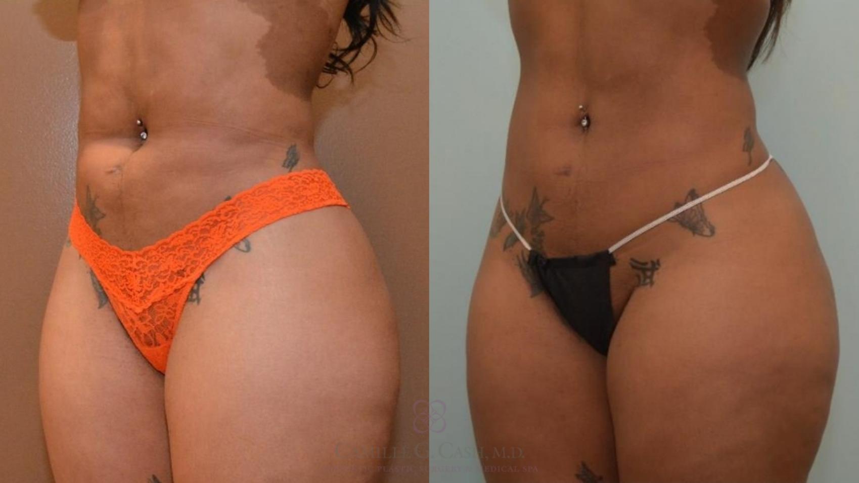 Before & After Liposuction Case 547 Right Oblique View in Houston, TX