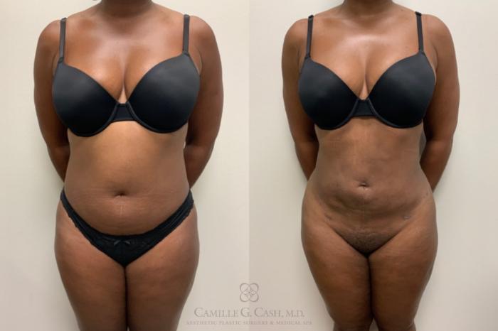 Before & After Liposuction Case 607 Front View in Houston, TX