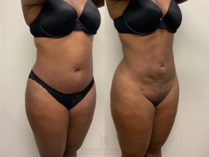 Before & After Liposuction Case 607 Left Oblique View in Houston, TX