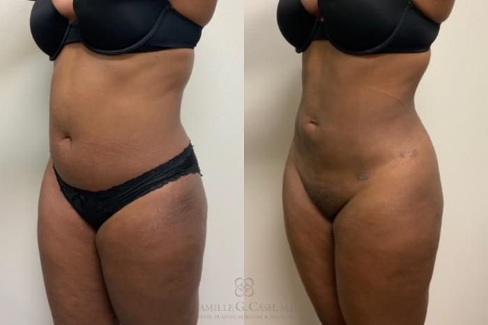 Before & After Liposuction Case 607 Right Oblique View in Houston, TX