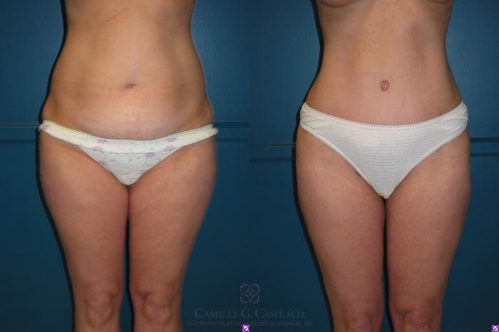 Before & After Liposuction Case 66 View #1 View in Houston, TX
