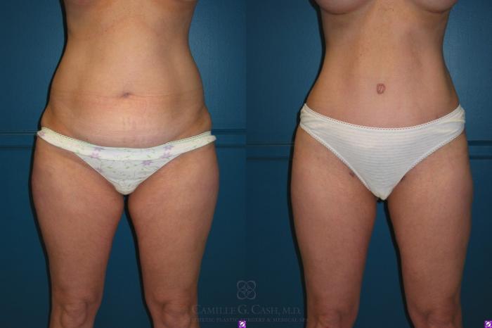Before & After Liposuction Case 66 View #2 View in Houston, TX