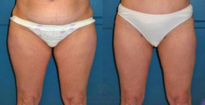 Before & After Liposuction Case 66 View #6 View in Houston, TX