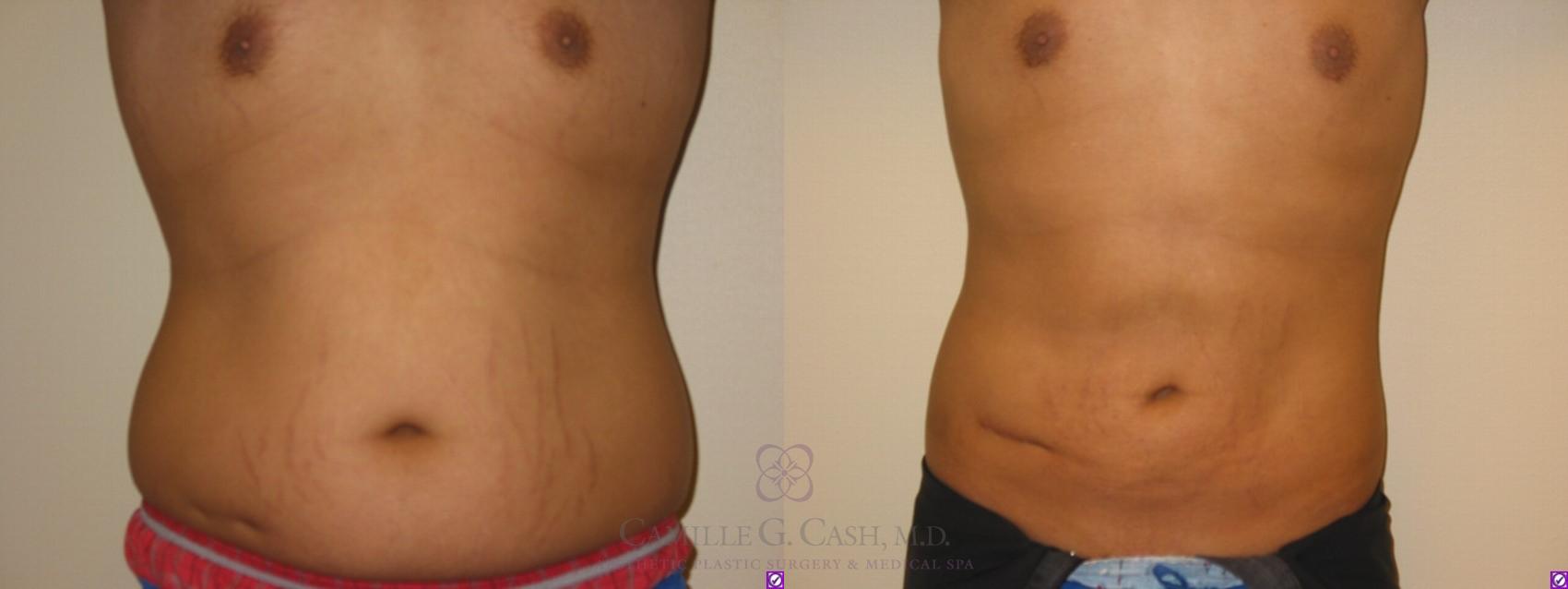 Before & After Liposuction Case 67 View #1 View in Houston, TX