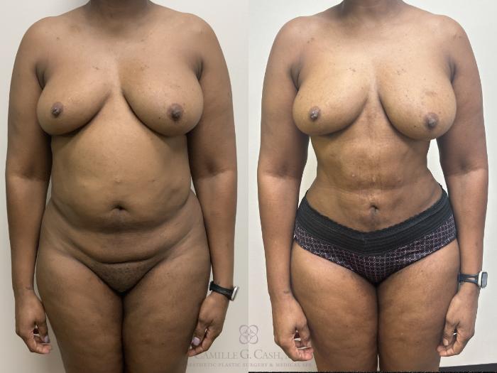 Before & After Liposuction Case 687 Front View in Houston, TX