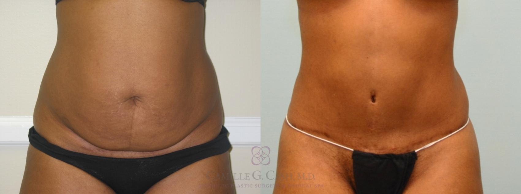 Before & After Liposuction Case 75 View #1 View in Houston, TX