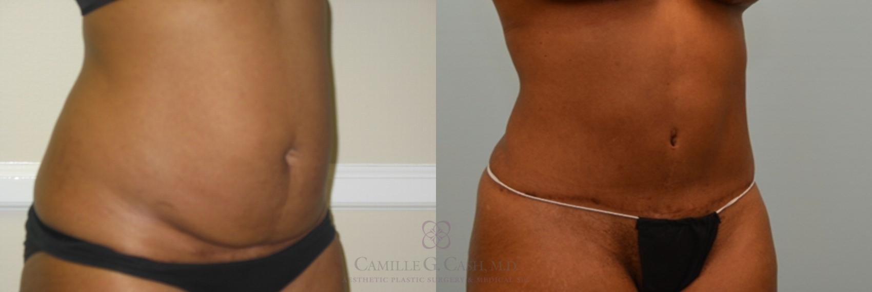 Before & After Liposuction Case 75 View #2 View in Houston, TX