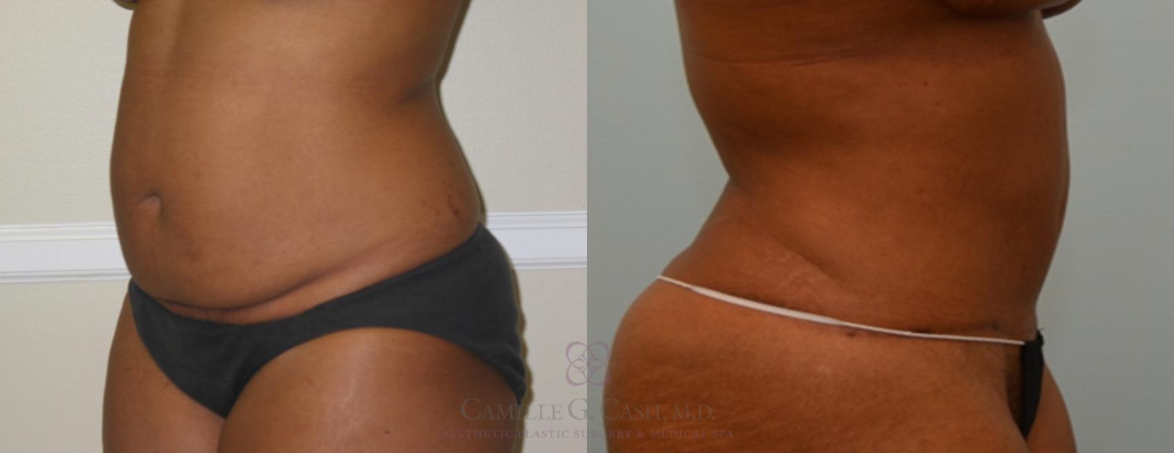 Before & After Liposuction Case 75 View #3 View in Houston, TX