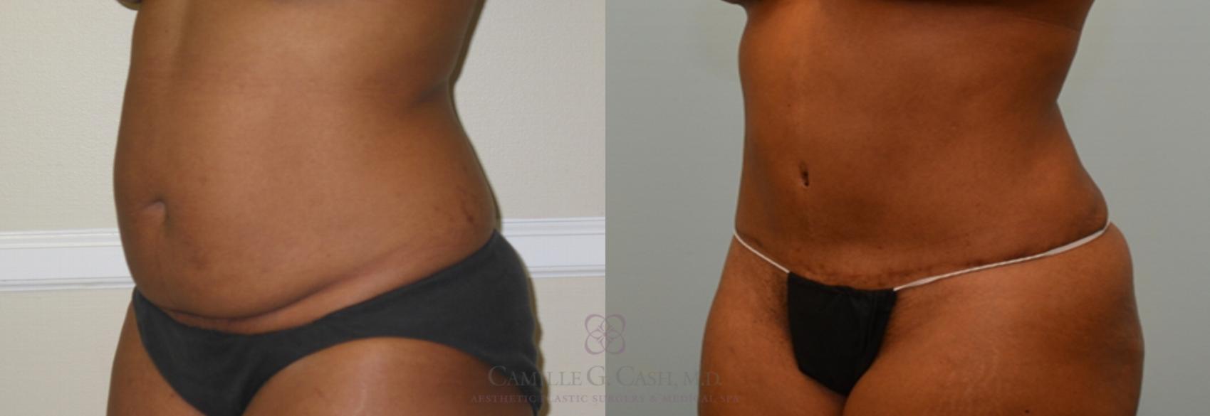Before & After Liposuction Case 75 View #4 View in Houston, TX
