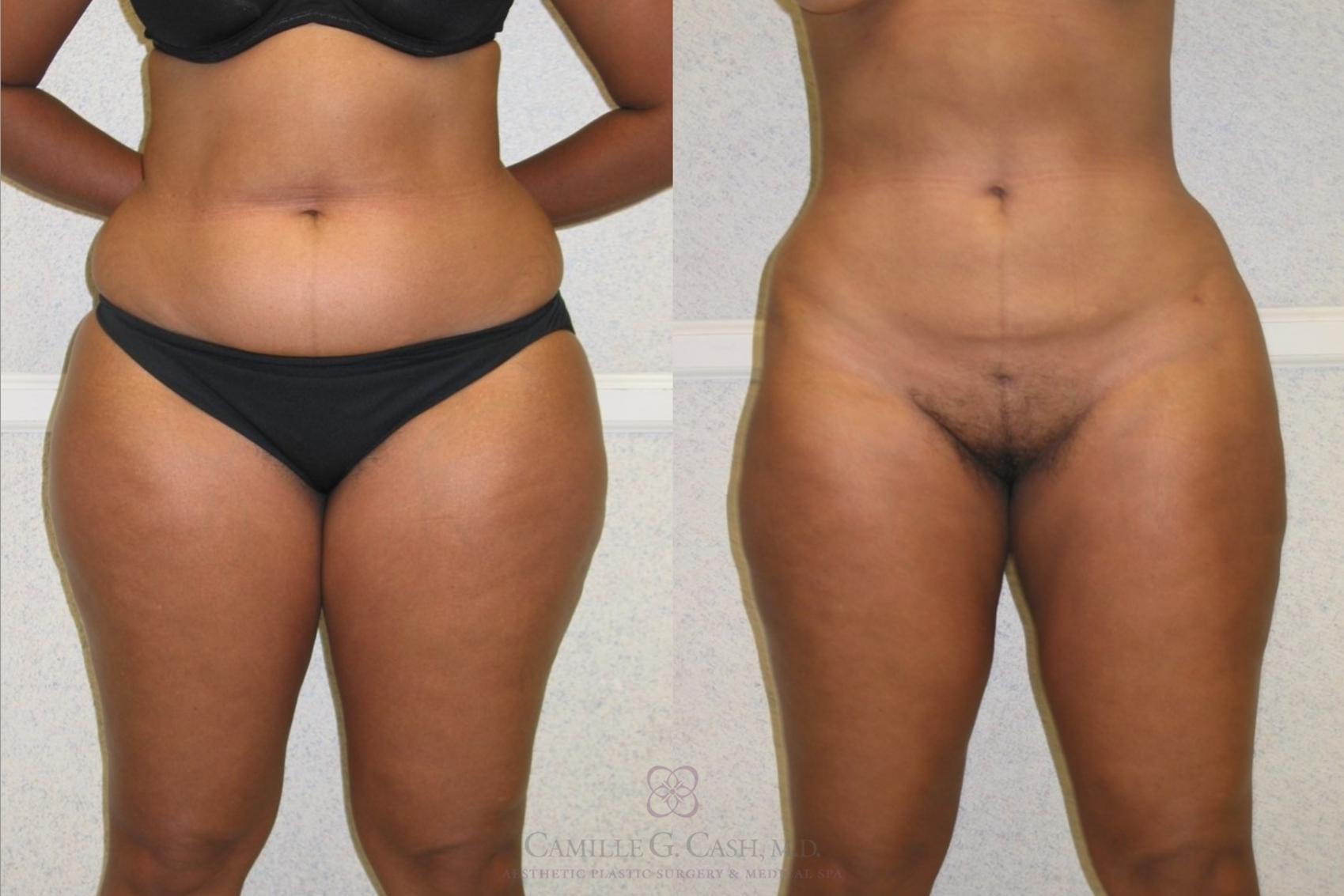 Before & After Liposuction Case 78 front 2 View in Houston, TX