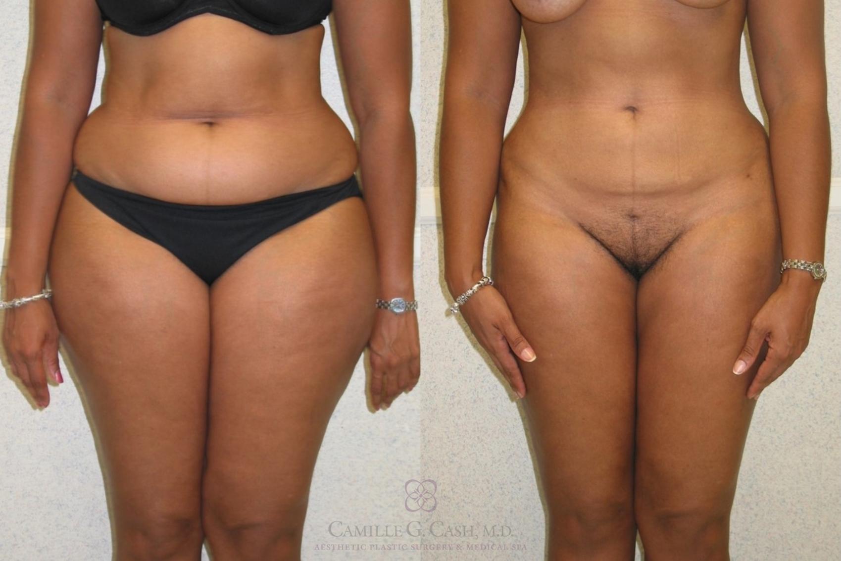 Before & After Liposuction Case 78 Front View in Houston, TX