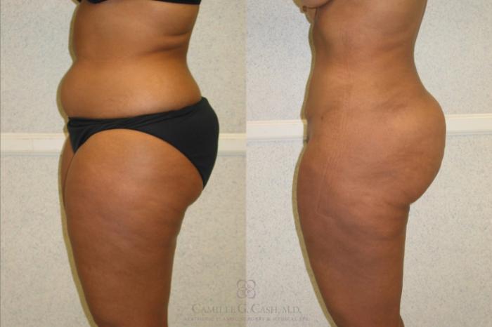 Before & After Liposuction Case 78 Right Side View in Houston, TX
