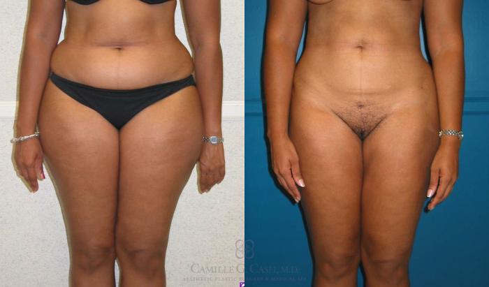 Before & After Liposuction Case 78 View #1 View in Houston, TX