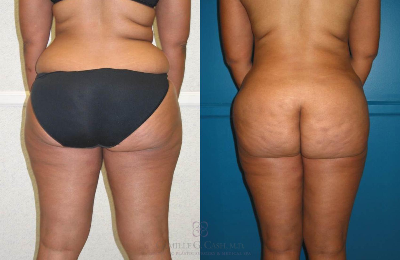 Before & After Liposuction Case 78 View #2 View in Houston, TX