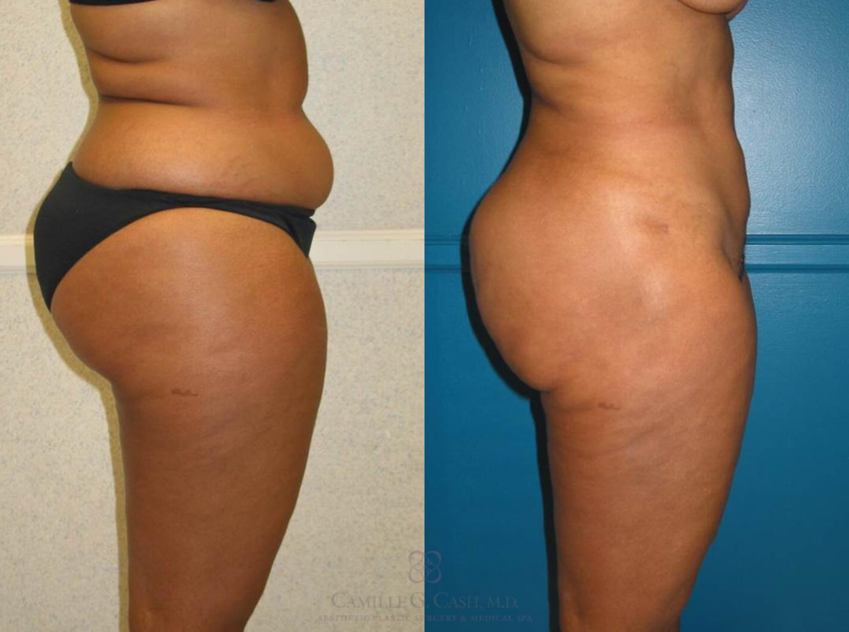 Before & After Liposuction Case 78 View #3 View in Houston, TX