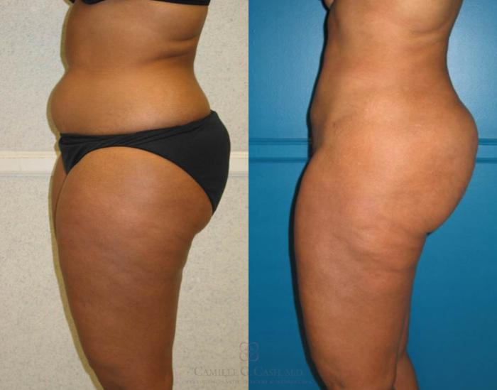 Before & After Liposuction Case 78 View #4 View in Houston, TX