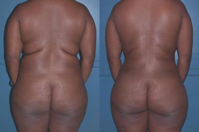 Before & After Liposuction Case 9 View #1 View in Houston, TX