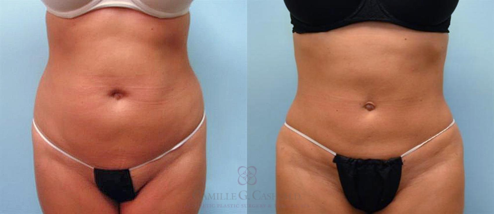 Before & After Liposuction Case 91 View #1 View in Houston, TX