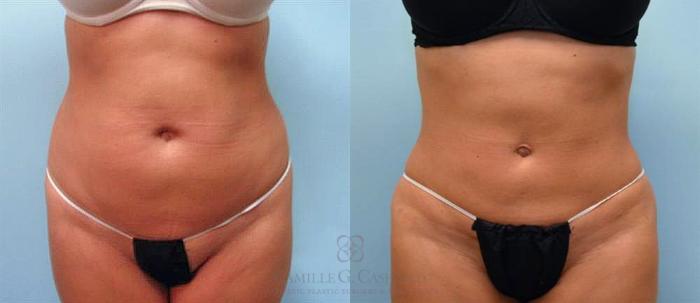 Before & After Liposuction Case 91 View #1 View in Houston, TX