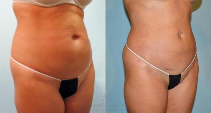 Before & After Liposuction Case 91 View #2 View in Houston, TX