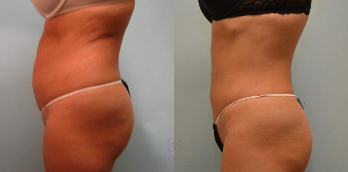 Before & After Liposuction Case 91 View #3 View in Houston, TX