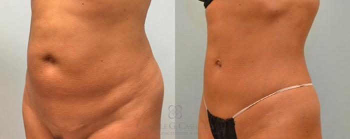 Before & After Liposuction Case 91 View #4 View in Houston, TX
