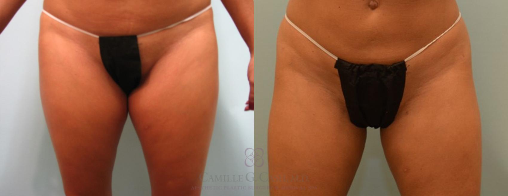 Before & After Liposuction Case 91 View #5 View in Houston, TX