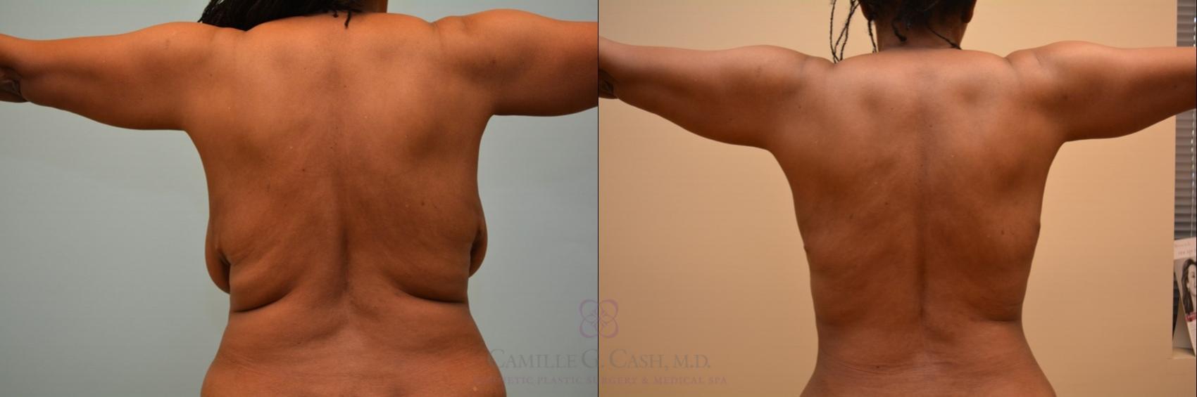 Before & After Liposuction Case 98 View #1 View in Houston, TX