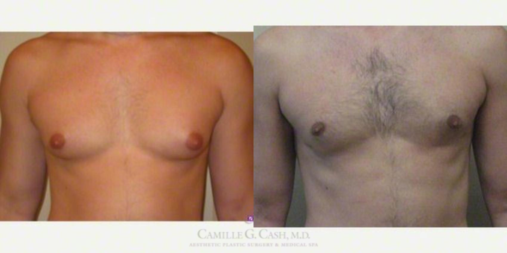 Before & After Male Breast Reduction Case 152 View #1 View in Houston, TX
