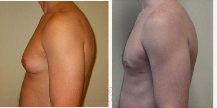 Before & After Male Breast Reduction Case 152 View #2 View in Houston, TX