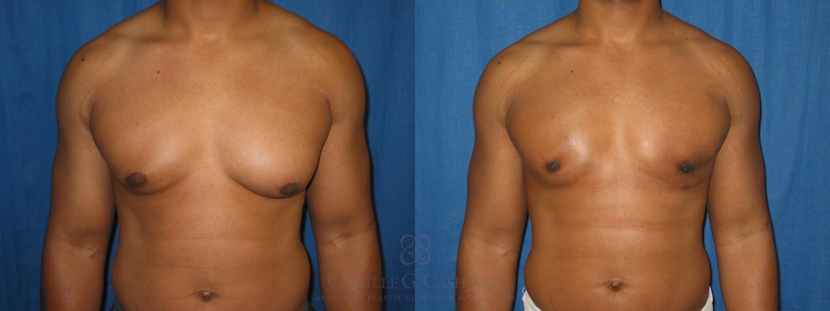 Before & After Male Breast Reduction Case 153 View #1 View in Houston, TX