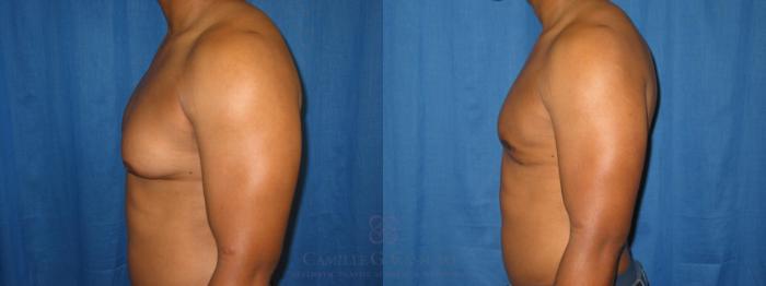 Before & After Male Breast Reduction Case 153 View #2 View in Houston, TX